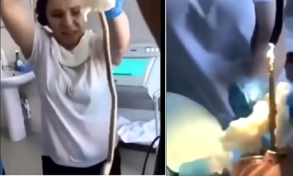 4 feet long snake removed from woman’s stomach during surgery